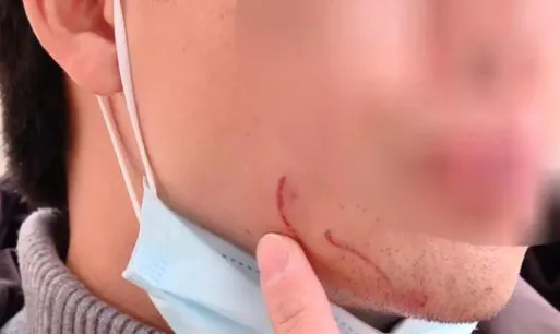 打人轻微伤怎么判